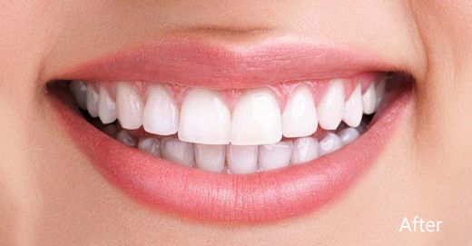 before & after gallery