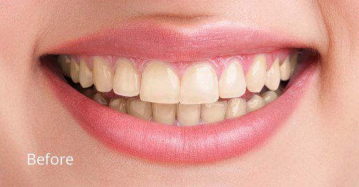 before & after gallery